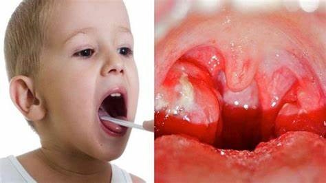 Viêm amidan ở trẻ em: nguyên nhân dấu hiệu và biện pháp điều trị